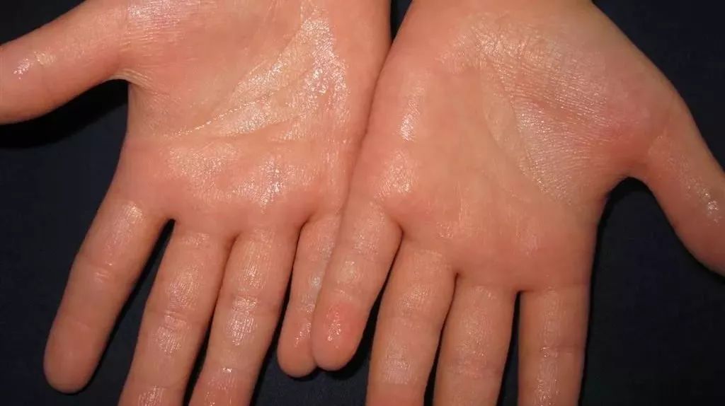 鸡皮肤运动出汗痒痒(鸡皮肤运动出汗痒痒怎么回事) 鸡皮肤运动出汗痒痒(鸡皮肤运动出汗痒痒怎么回事)