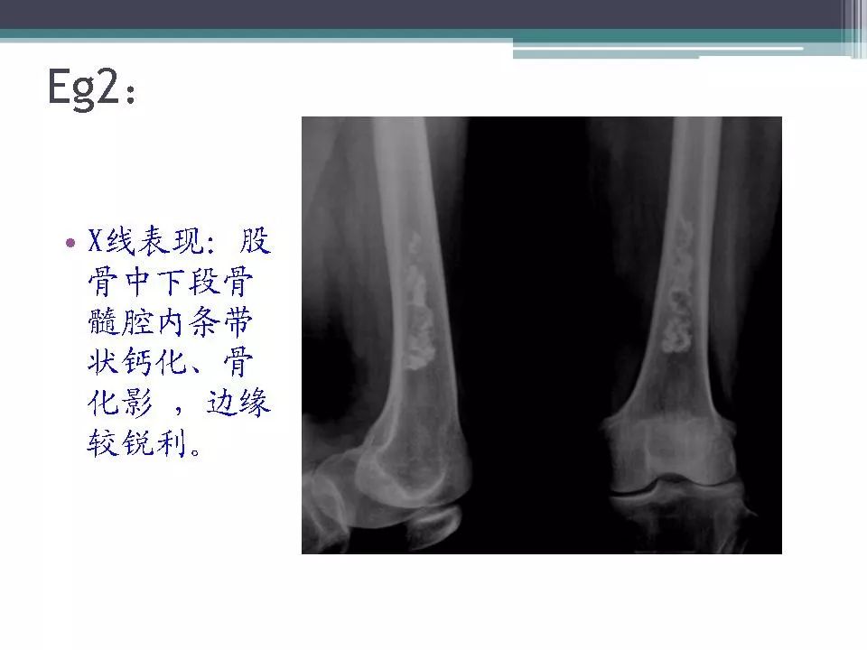 骨梗死的影像诊断影像天地