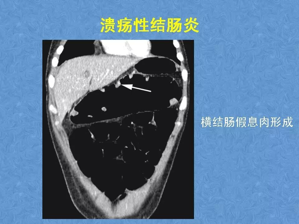 炎症性肠病的ct诊断影像天地