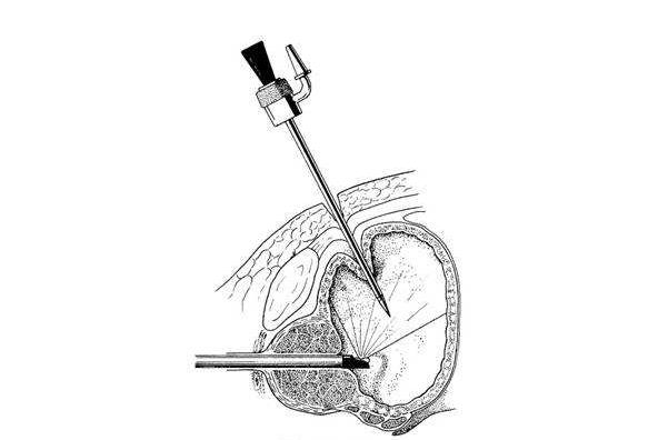 潘医生前列腺炎为什么不推荐使用抗菌素治疗