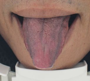 舌头背面血管发紫图片