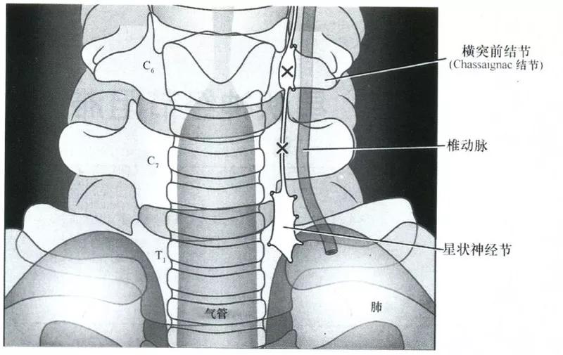 星状神经节位置图图片