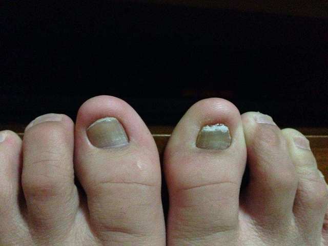 得了灰指甲会不会传染俩