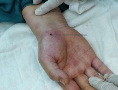 宁津县中医院骨科前沿小切口无缝合手腕骨折的手术也可以微创