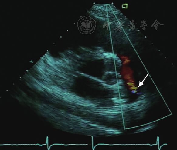 影像检验02胸骨旁短轴切面的获取与图像判读