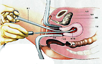 为生儿子,被婆婆逼着人流9次,最终命陨手术台!