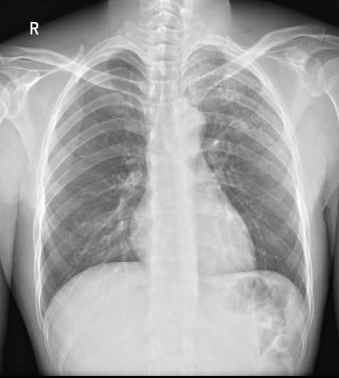 肺结核x线表现图片