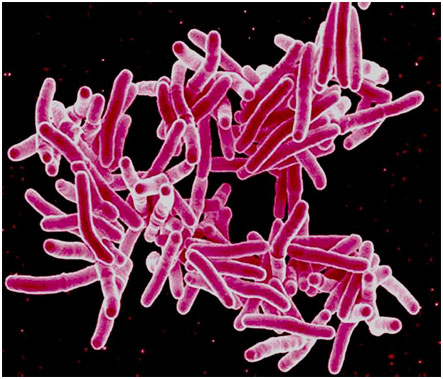 耐多药结核病如何预防大型临床试验正在进行中