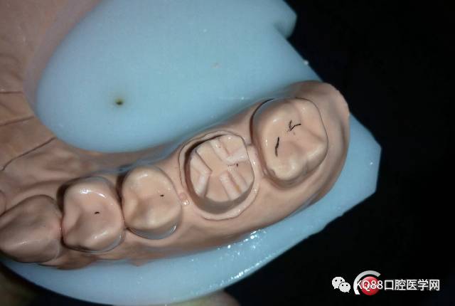 快速磨牙全冠预备