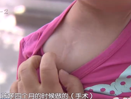 新生儿臂丛神经损伤 莱西市人民医院支付26万后不履行协议