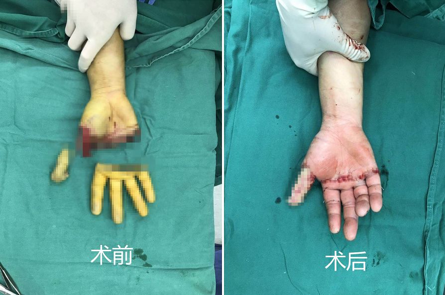 他们将在约两周后,再次为患者进行部分拇指组织再造术.