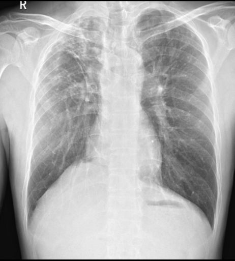 肺结核x线表现图片