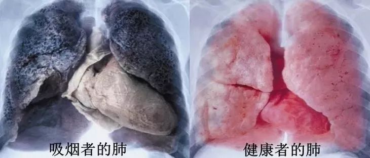 二手烟的肺部图片图片