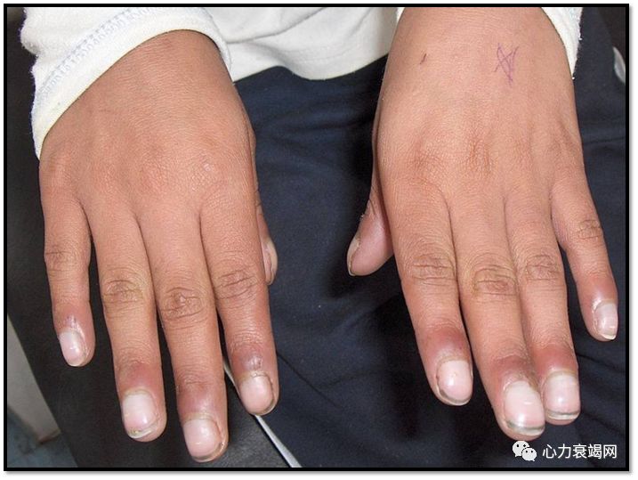 杵状指,四肢湿冷,双下肢轻度水肿.