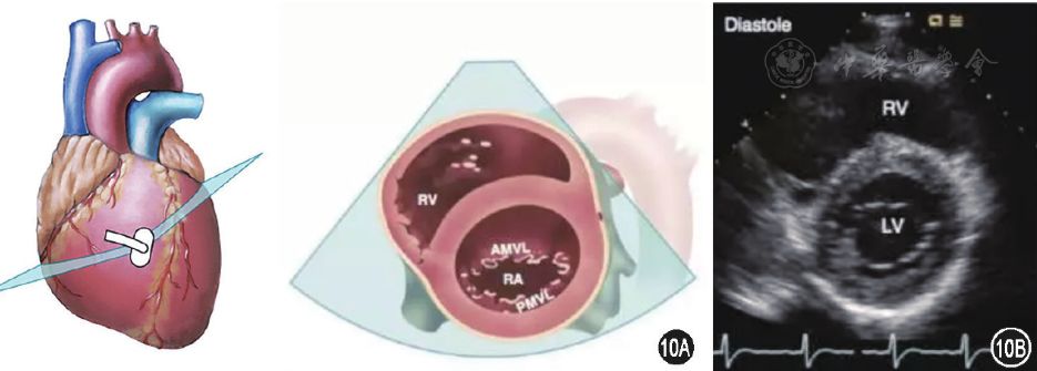 圖10胸骨旁左心室短軸二尖瓣水平切面的解剖示意圖(圖10a)及超聲圖像
