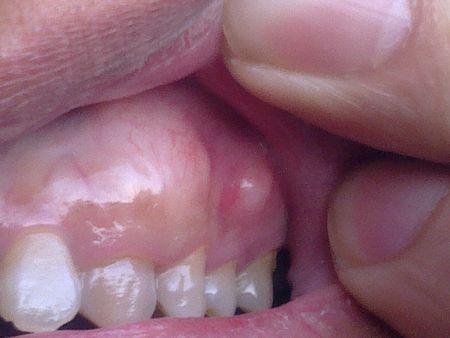 那么牙槽骨骨质增生是由什么引起的呢?