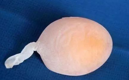 还在为异形鸡蛋发愁别愁了是输卵管炎在作祟