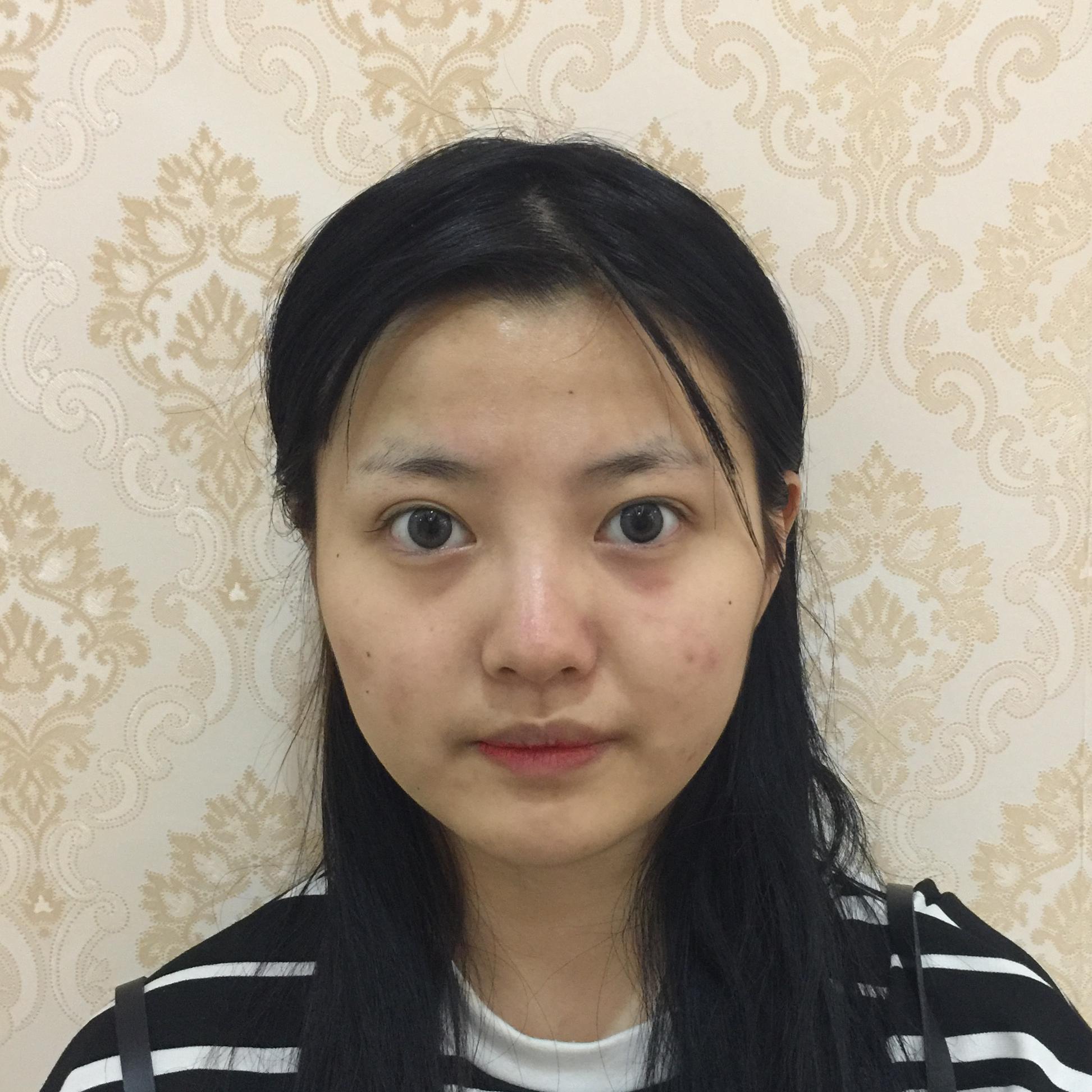 最自然好看的双眼皮长什么样