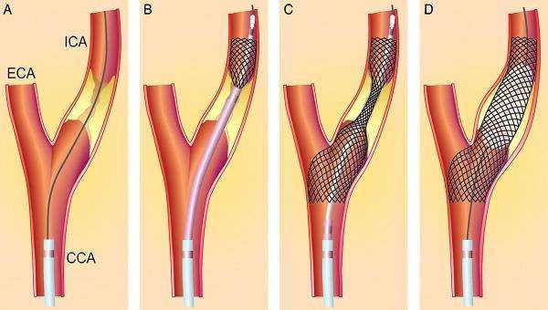 对于不能进行手术或者支架置入的患者,生活方式的调整和药物治疗尤为