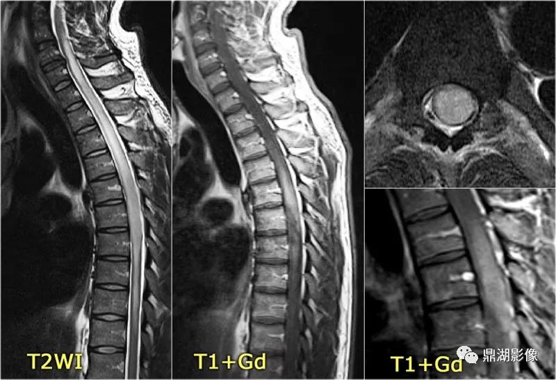 病理】源于脊髓中央管或终丝终室内的室管膜细胞,约为脊髓胶质瘤的60%