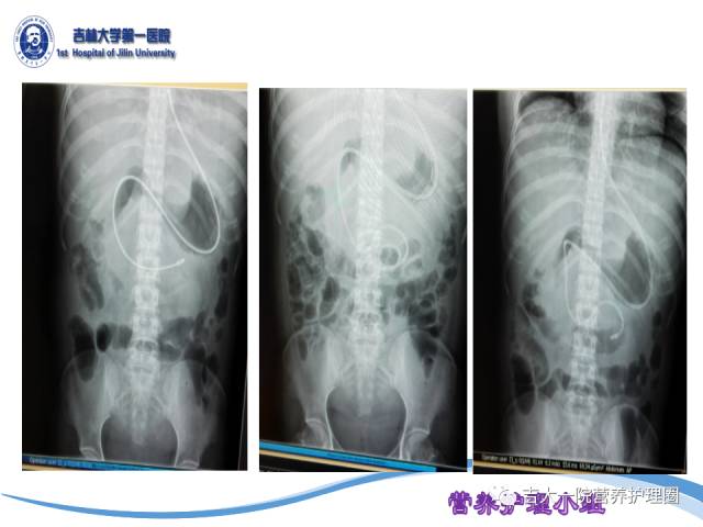 鼻肠管留置的位置如何判定?ppt全面告诉你!