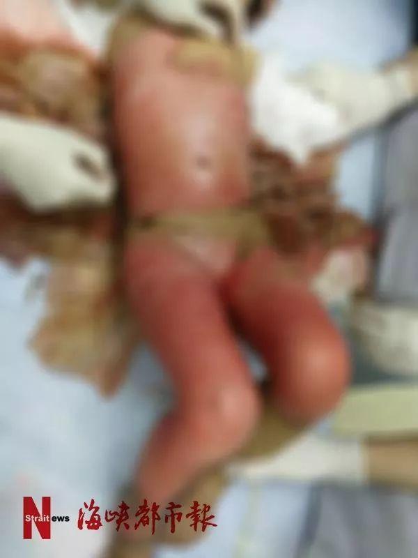 触目惊心福州女童全身近半烫伤家有孩子千万注意这4点