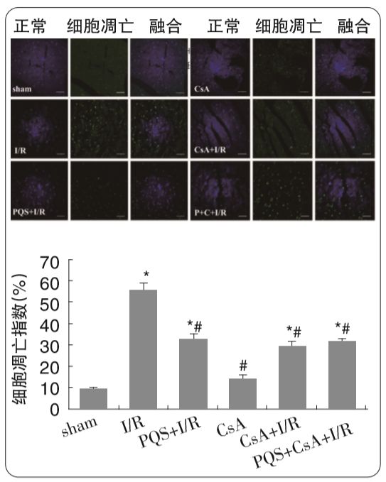 心悦胶囊改善急性心梗血运重建后心肌灌注