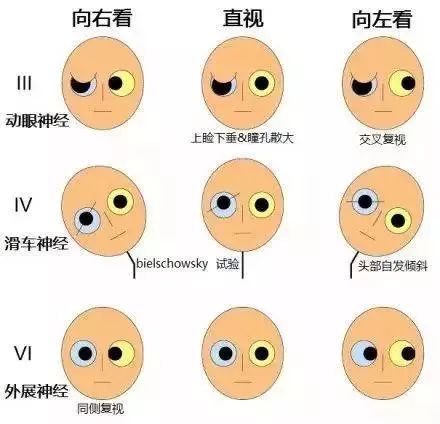 脑疝的分型几种类型脑出血的ct表现各种颅内出血不同部位脑病的瞳孔