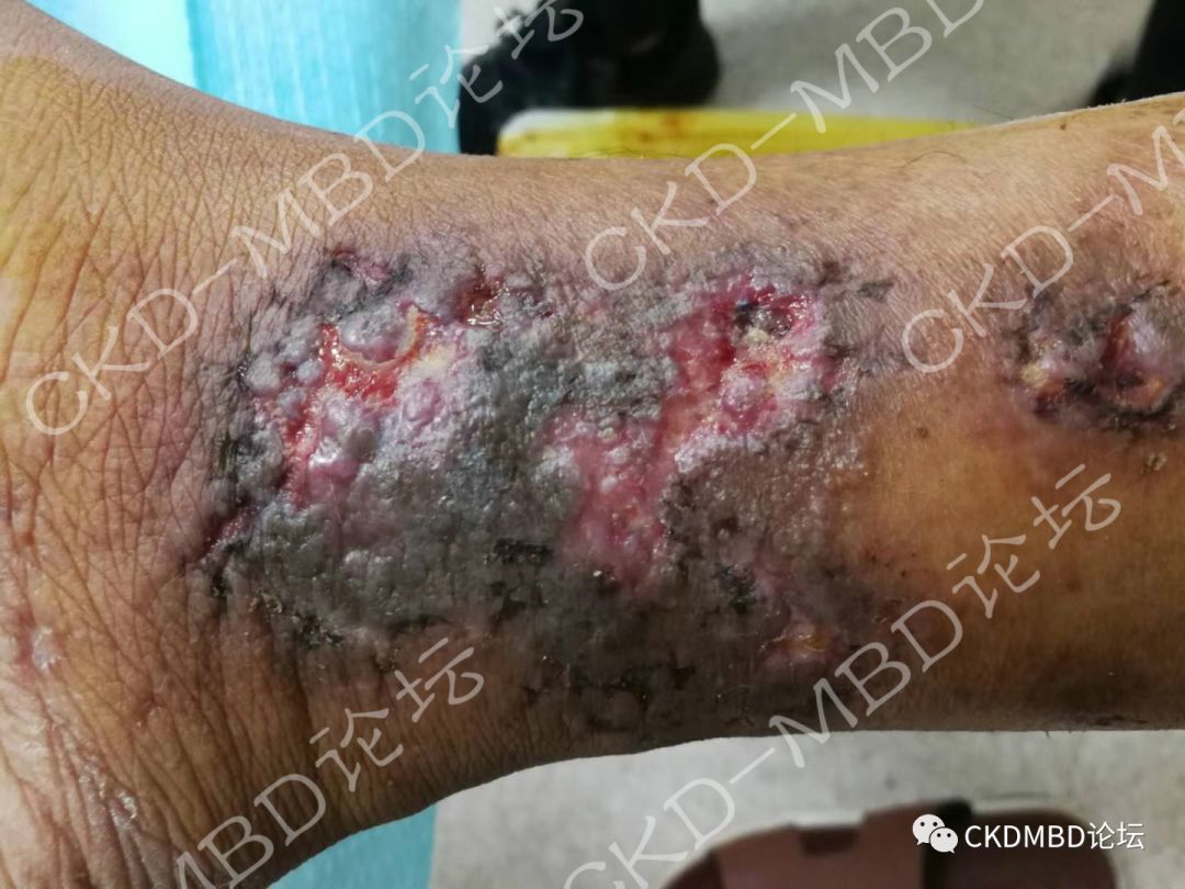 关于慢性肾脏病钙化防御的50个关键问题(一)