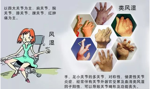 类风湿就是风湿?不清楚症状就乱治,小心越治越严重