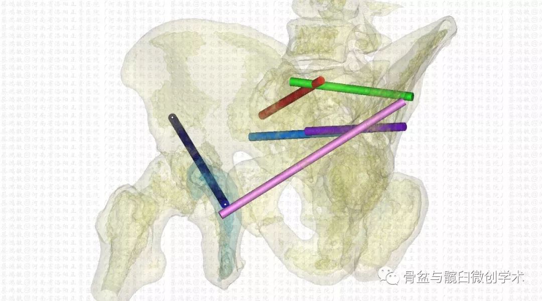 認識彈性回縮力掃清骨盆骨折分型診斷的最後障礙一例特殊骨盆骨折的分