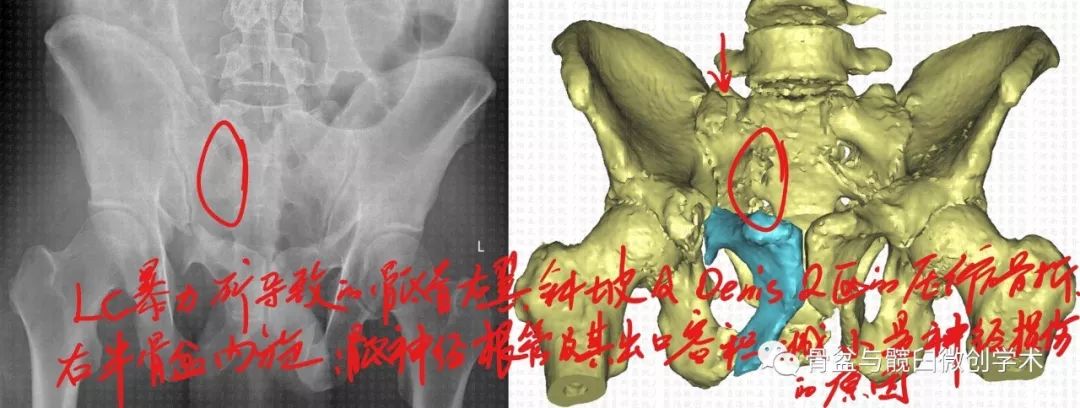 2區腹側骨皮質向背側凹陷,部分骨折塊翻轉,導致右半骨盆內旋移位,骶