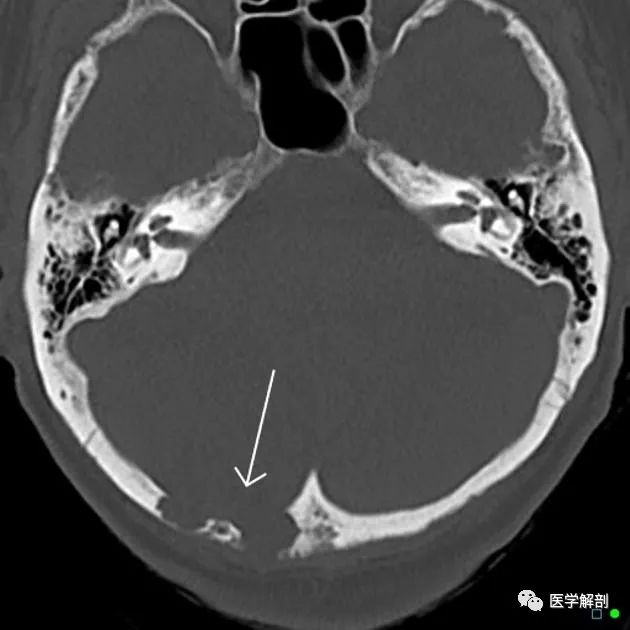 (2)颅缝与囟:冠状缝自颅穹隆前中1/3交界处下行
