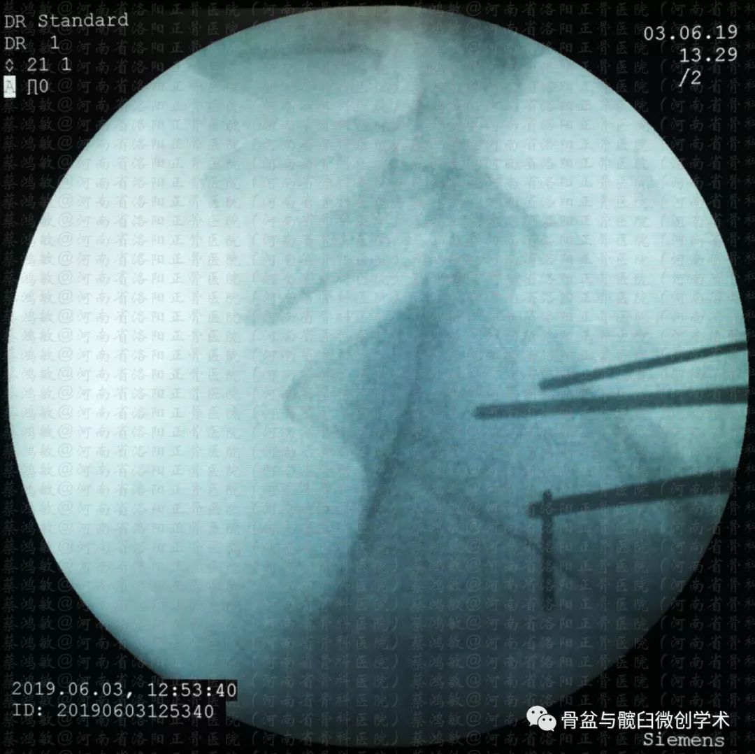 認識彈性回縮力掃清骨盆骨折分型診斷的最後障礙一例特殊骨盆骨折的分