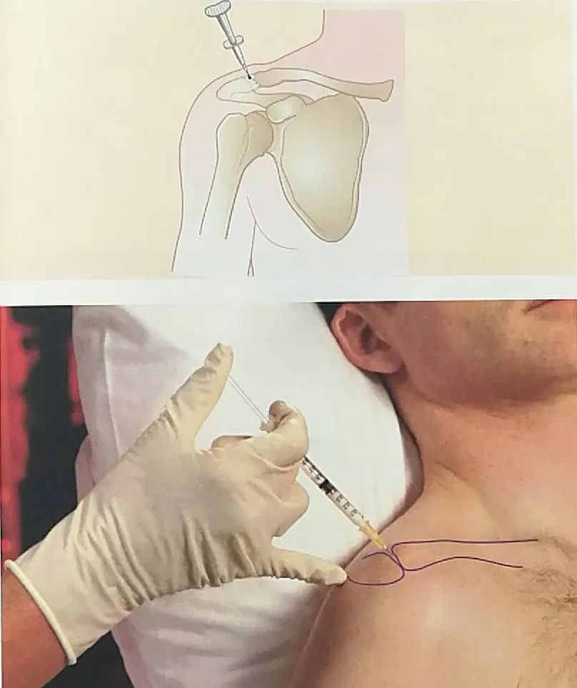 肩关节封闭注射部位图图片