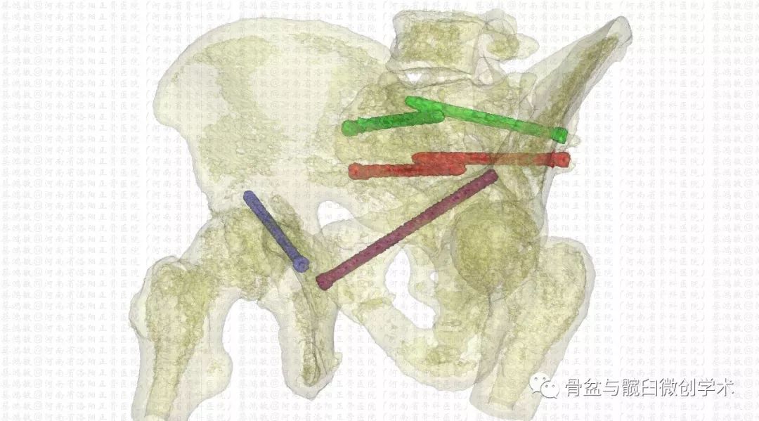 認識彈性回縮力掃清骨盆骨折分型診斷的最後障礙一例特殊骨盆骨折的分