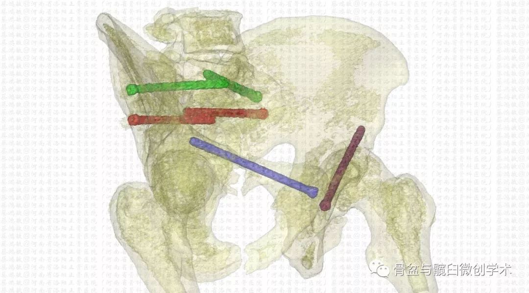 認識彈性回縮力掃清骨盆骨折分型診斷的最後障礙一例特殊骨盆骨折的分