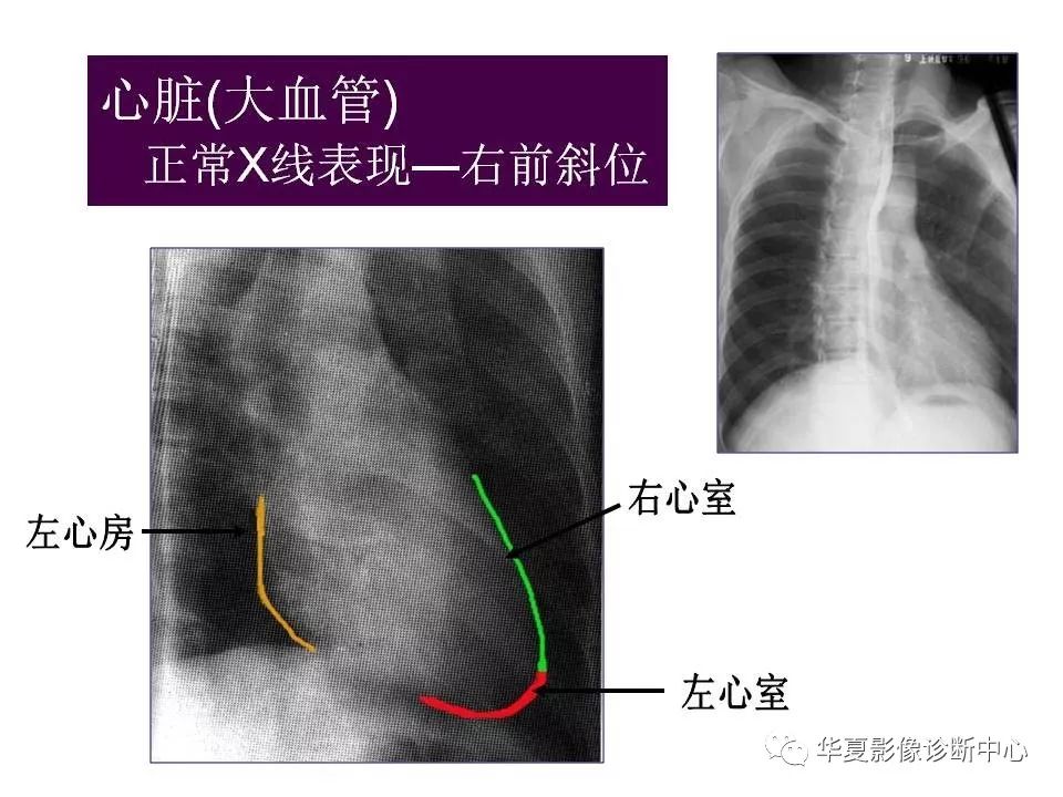 心脏左前斜位图片