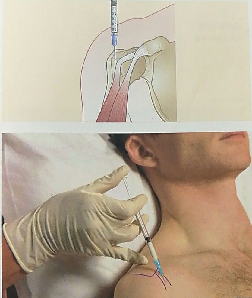 肩关节封闭治疗图解图片