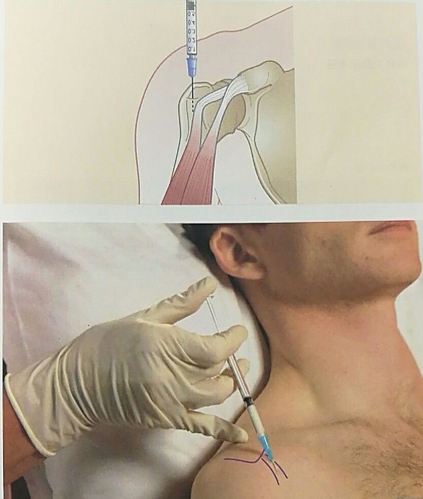 肩峰下滑囊注射图片
