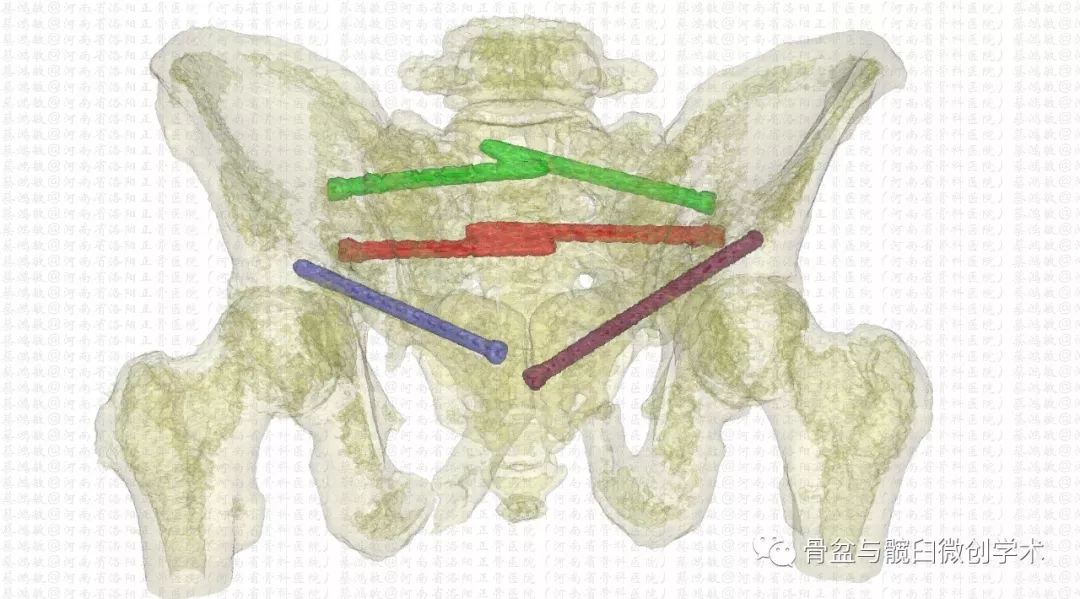 診斷的最後障礙一例特殊骨盆骨折的分型診斷及微創治療附透視次數計算