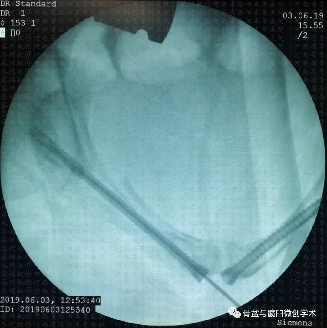 認識彈性回縮力掃清骨盆骨折分型診斷的最後障礙一例特殊骨盆骨折的分