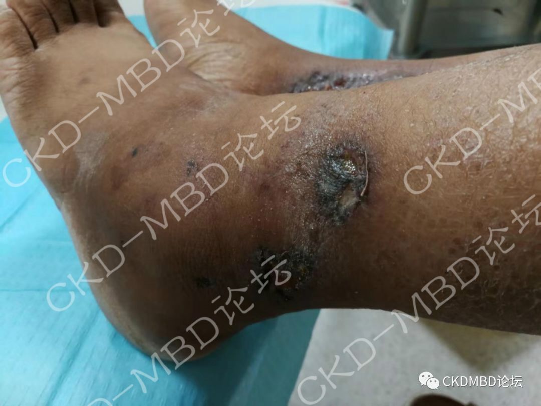 关于慢性肾脏病钙化防御的50个关键问题(一)