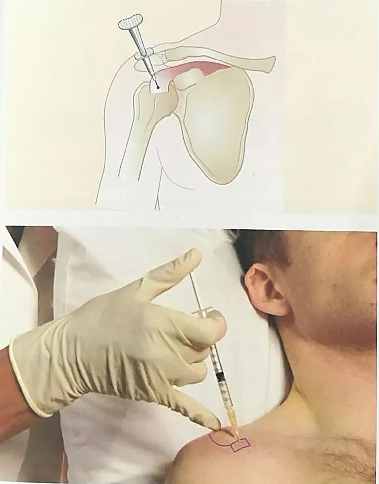 肩关节封闭治疗图解图片