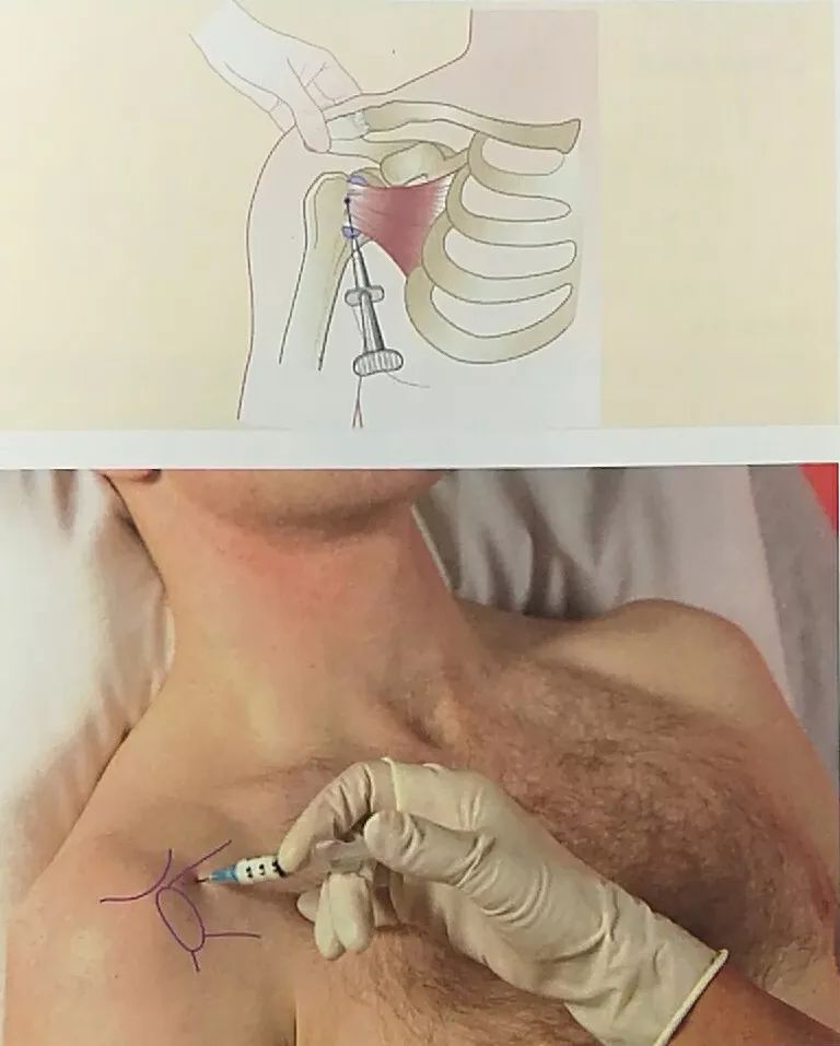 肘关节封闭注射示意图图片