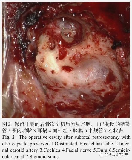 巖骨次全切除術的臨床應用