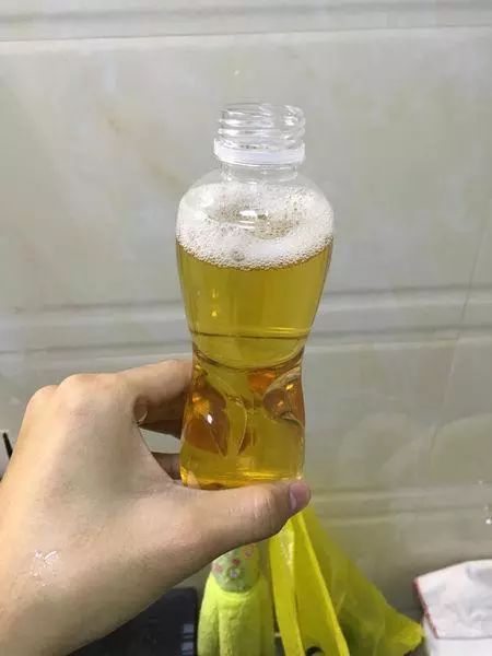 并且还有水肿,肉眼血尿,夜尿增多,高血压,糖尿病等情况,一定要及时去