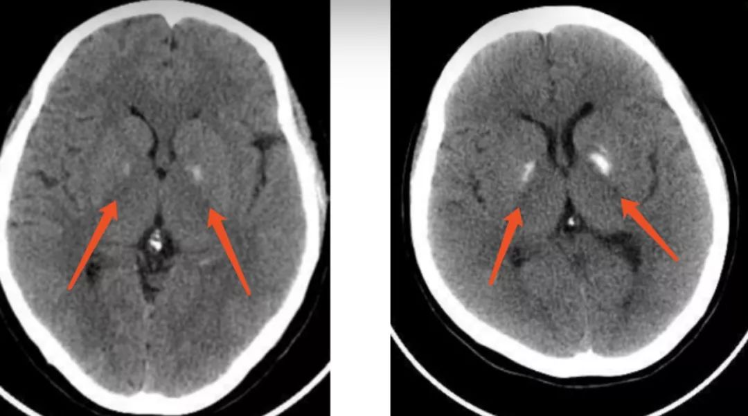 这种病不仅会使脑袋里长石头还会遗传