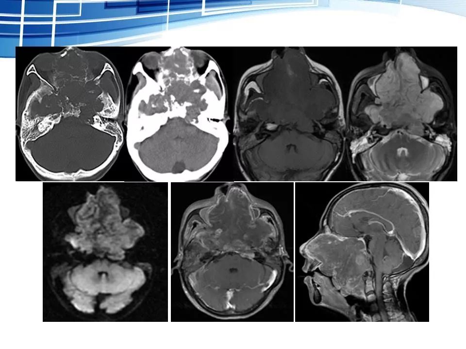 侵袭性垂体瘤mr征象分析影像天地