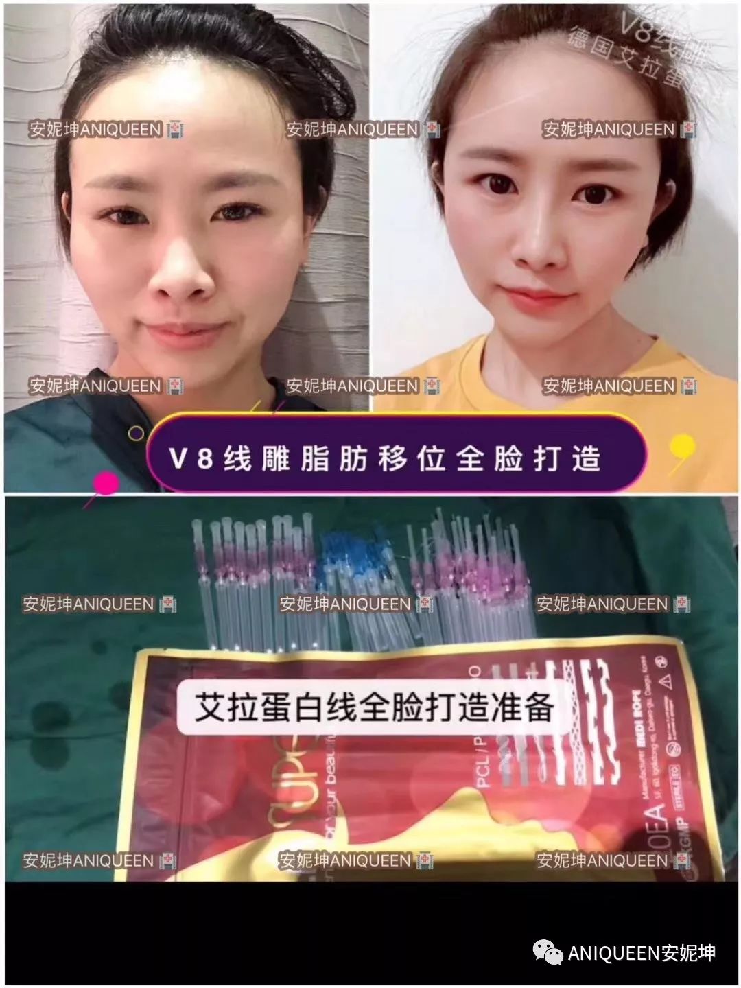 为什么说女人30岁后一定要做线雕?